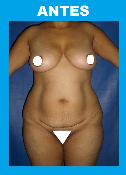 Antes 5