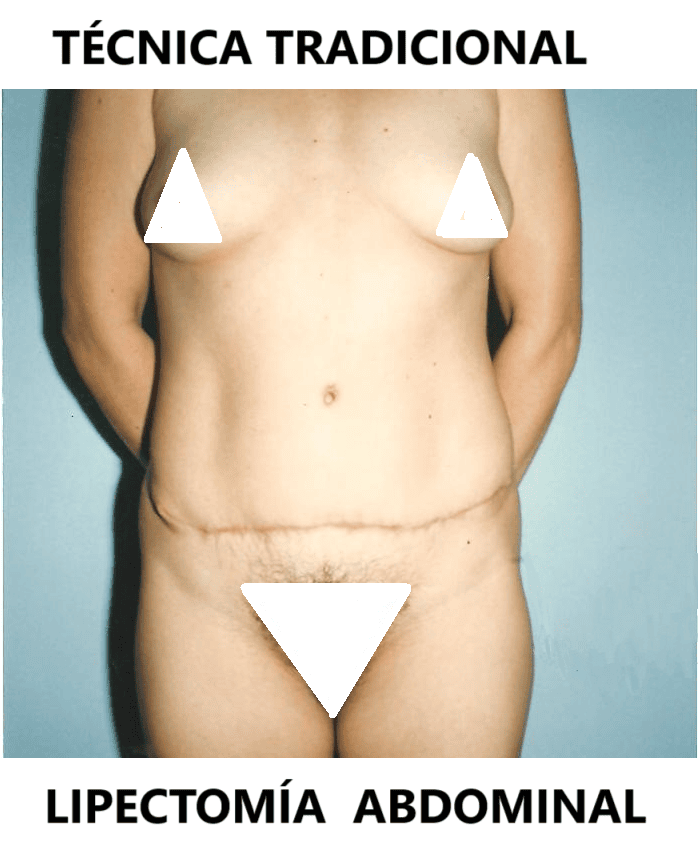 Lipectomía Abdominal Clásica