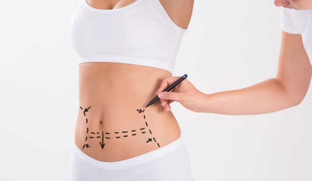 Diferencias entre la liposucción para hombres y mujeres